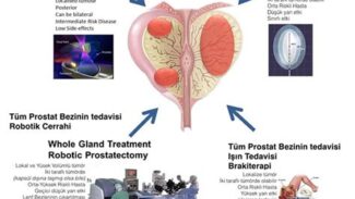 Prostat Hastalığı ve Tedavisi