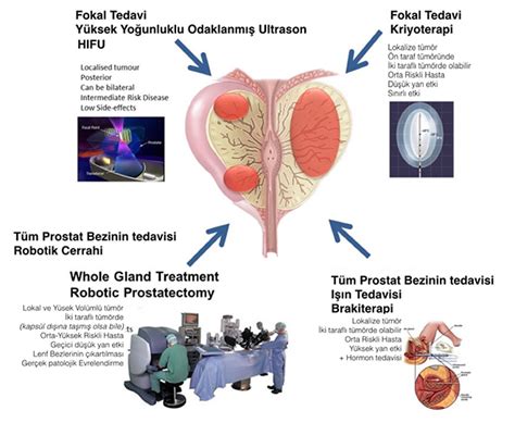 Prostat Hastalığı ve Tedavisi